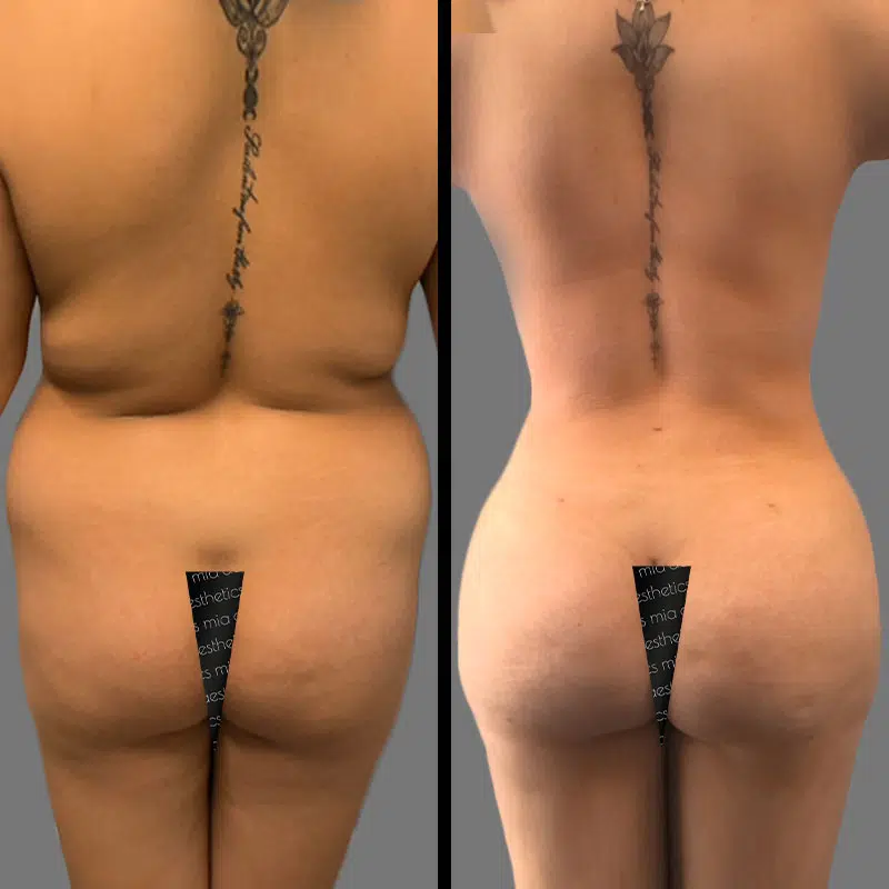 Dr. Penukonda BBL - Before & After 1