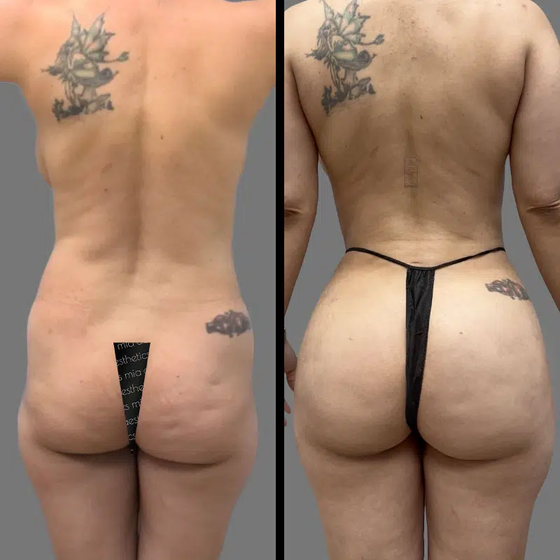 Dr. Vuu Brazilian Butt Lift - Before & After 1