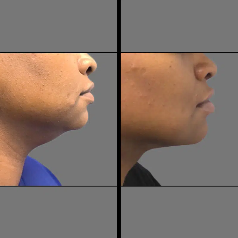 Dr. Vuu Chin Lipo - Before & After 2