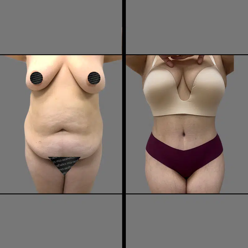 Dr. Vuu Tummy Tuck - Before & After 1