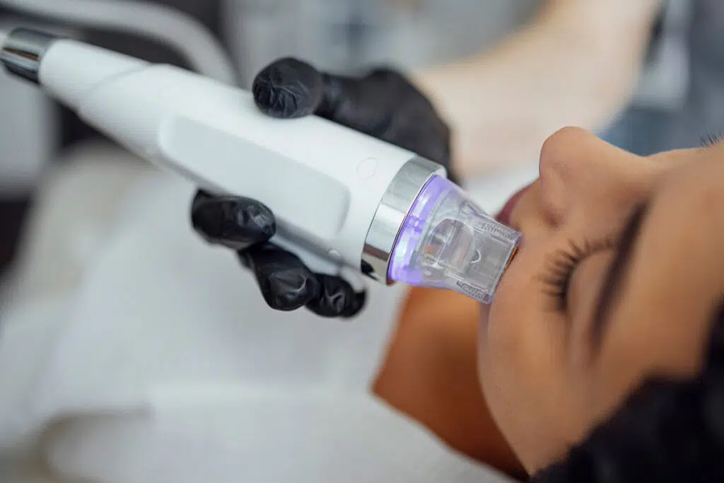 Close-up of a microneedling handpiece with an illuminated cartridge tip pressed against a woman's cheek