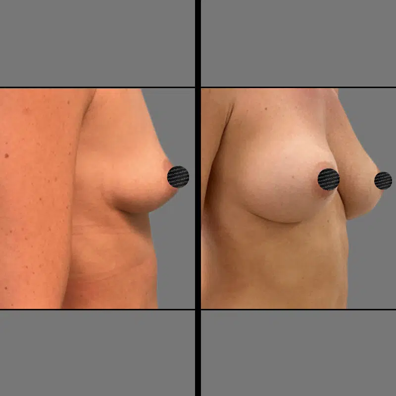 Dr. Le Breast Augmentation - Before & After 1