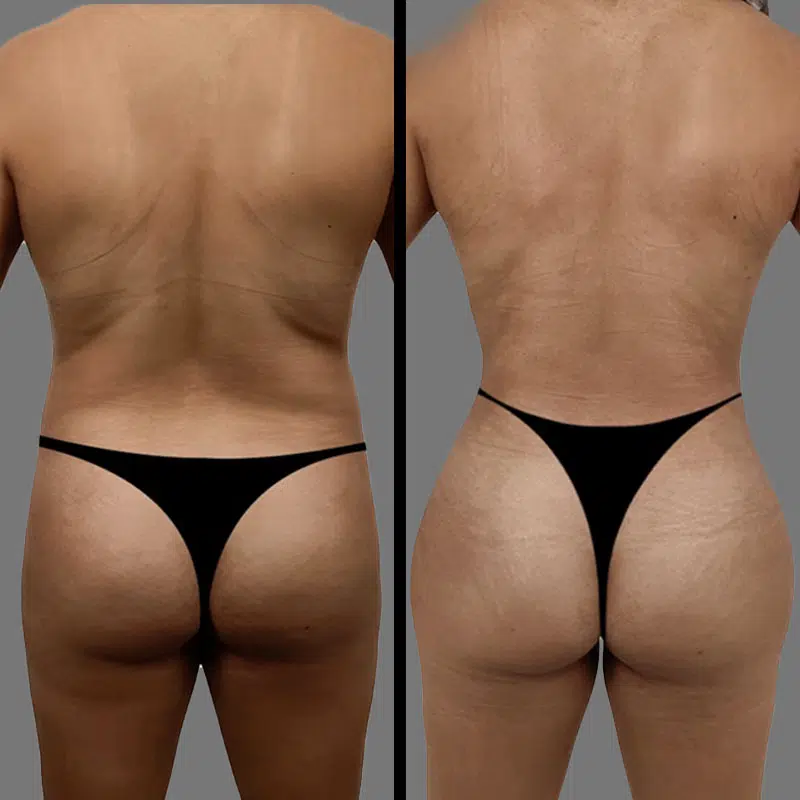 Dr. Le BBL - Before & After 1