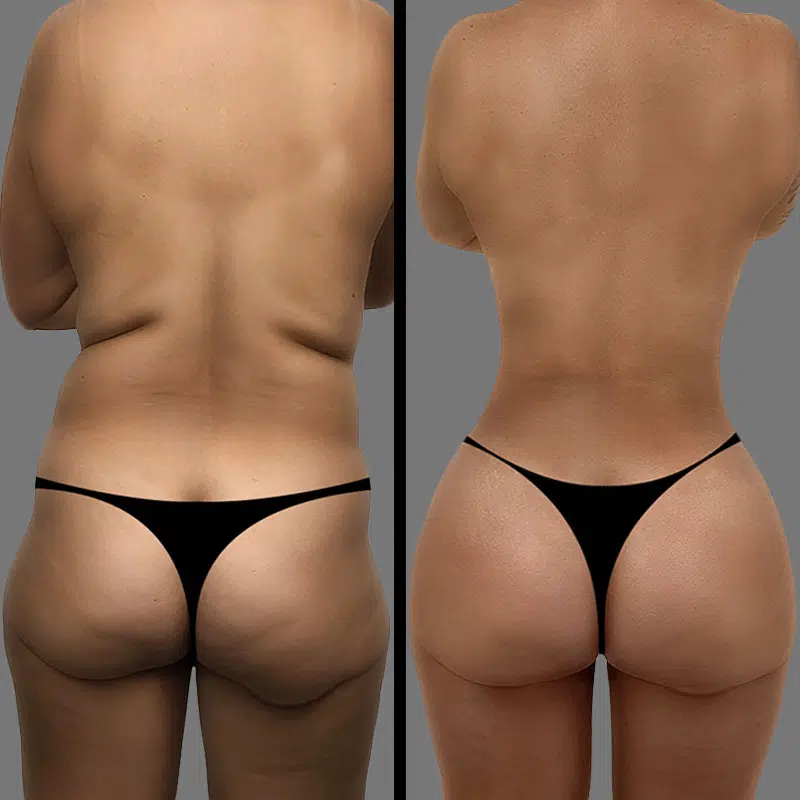 Dr. Le BBL - Before & After 2
