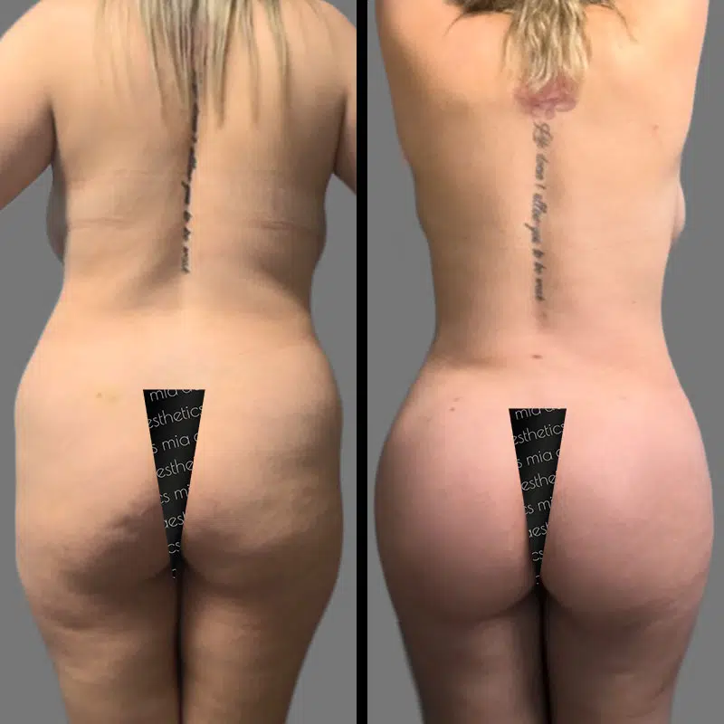 Dr. Young BBL - Before & After 1
