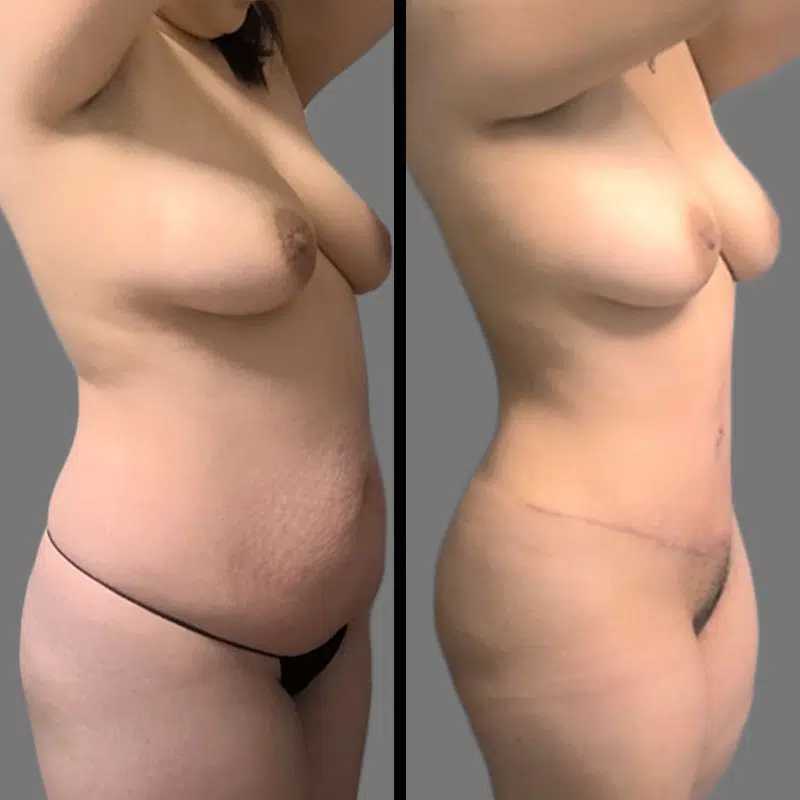 Dr. Young Tummy Tuck - Before & After 1