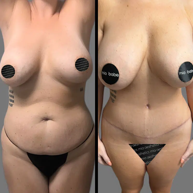 Dr. Young Tummy Tuck - Before & After 2